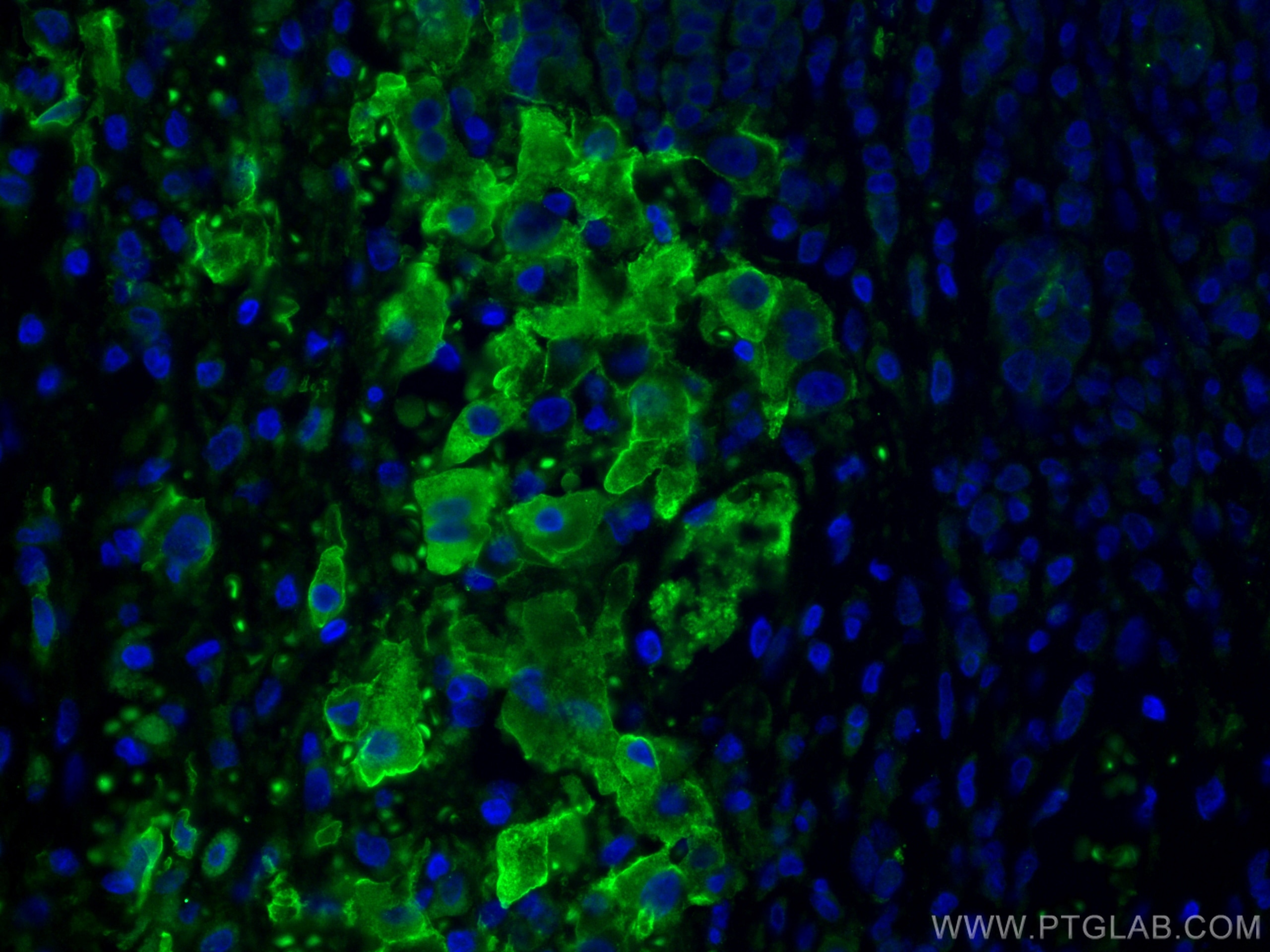 Immunofluorescence (IF) / fluorescent staining of human liver cancer tissue using Apolipoprotein H Monoclonal antibody (66074-1-Ig)
