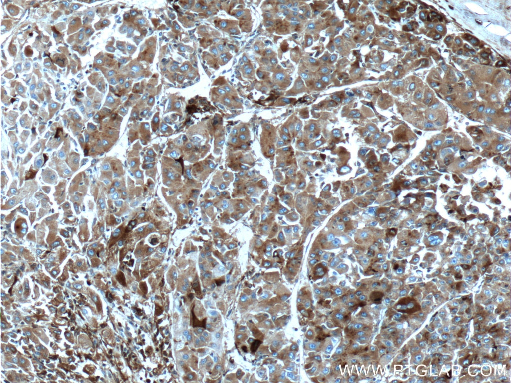 Immunohistochemistry (IHC) staining of human liver cancer tissue using Apolipoprotein H Monoclonal antibody (66074-1-Ig)