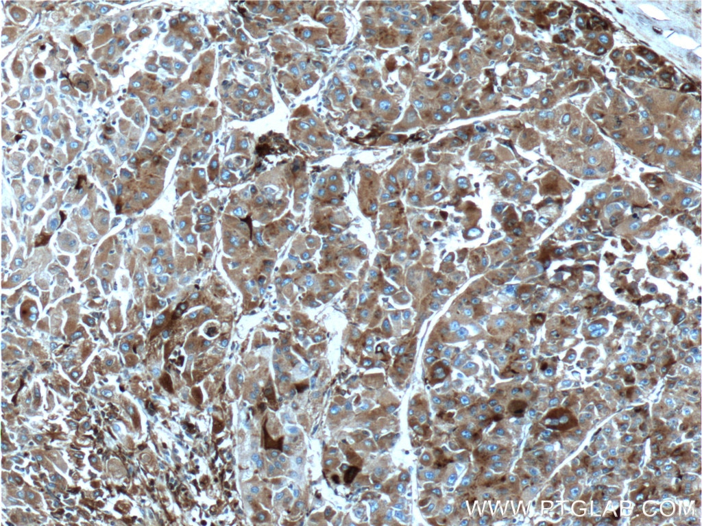 IHC staining of human liver cancer using 66074-1-Ig