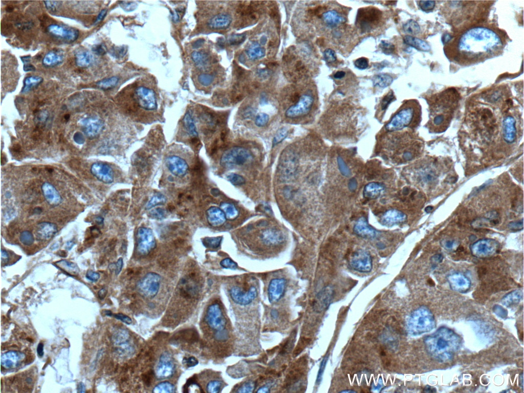 Immunohistochemistry (IHC) staining of human liver cancer tissue using Apolipoprotein H Monoclonal antibody (66074-1-Ig)