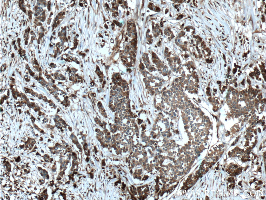 IHC staining of human colon cancer using 66074-1-Ig