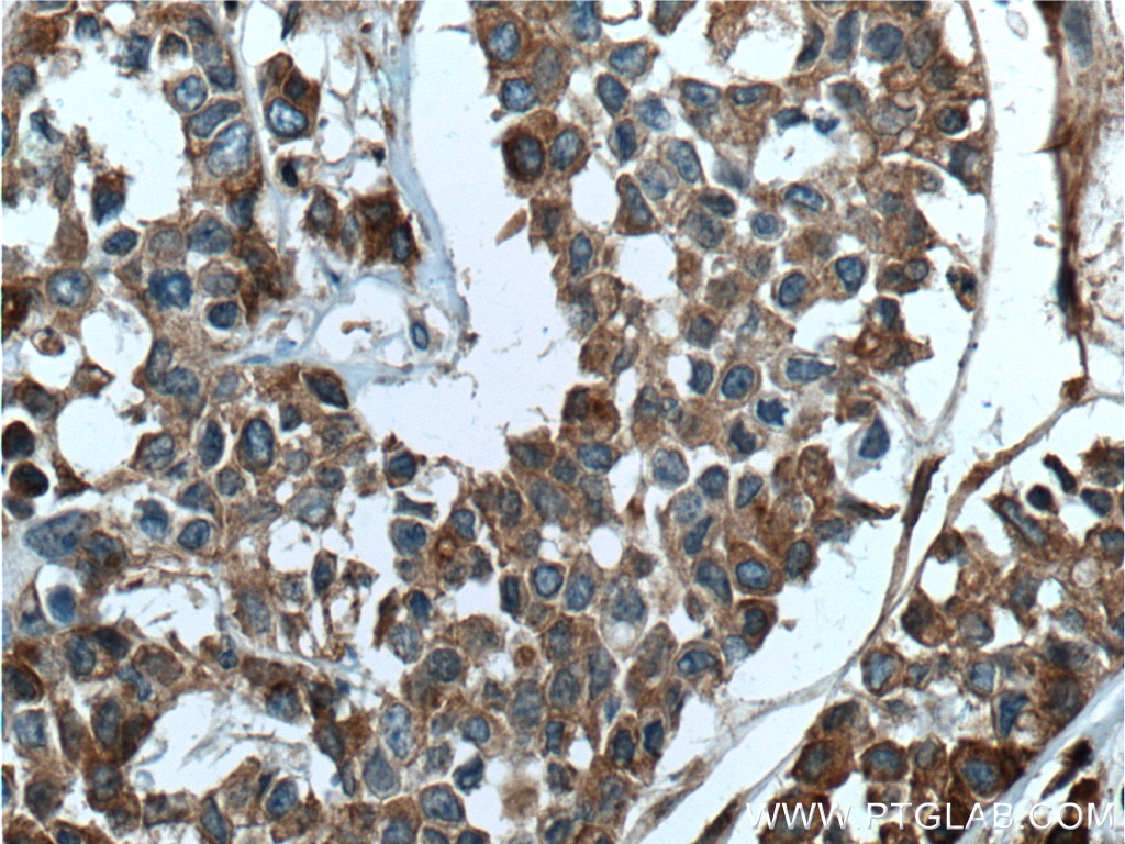 Immunohistochemistry (IHC) staining of human colon cancer tissue using Apolipoprotein H Monoclonal antibody (66074-1-Ig)