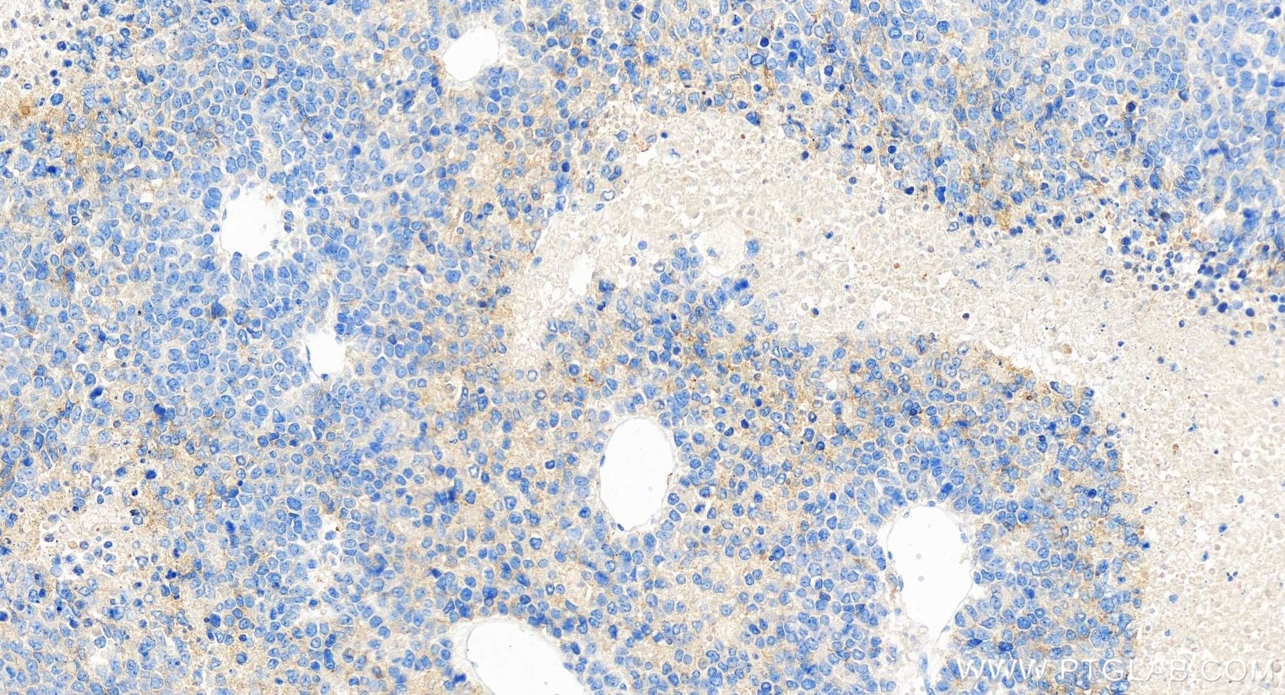Immunohistochemistry (IHC) staining of human liver cancer tissue using APOH Recombinant antibody (84943-2-RR)