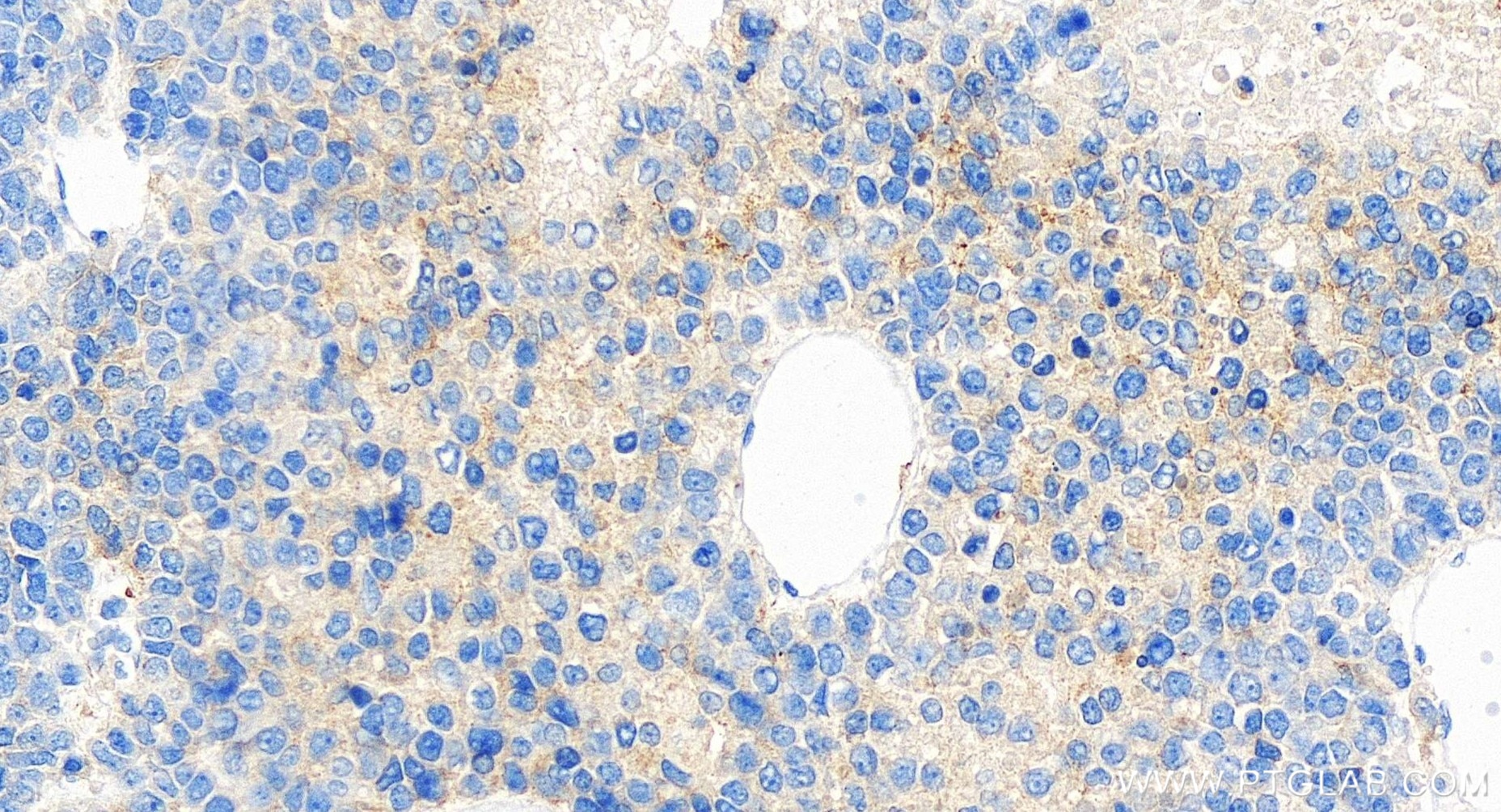 Immunohistochemistry (IHC) staining of human liver cancer tissue using APOH Recombinant antibody (84943-2-RR)