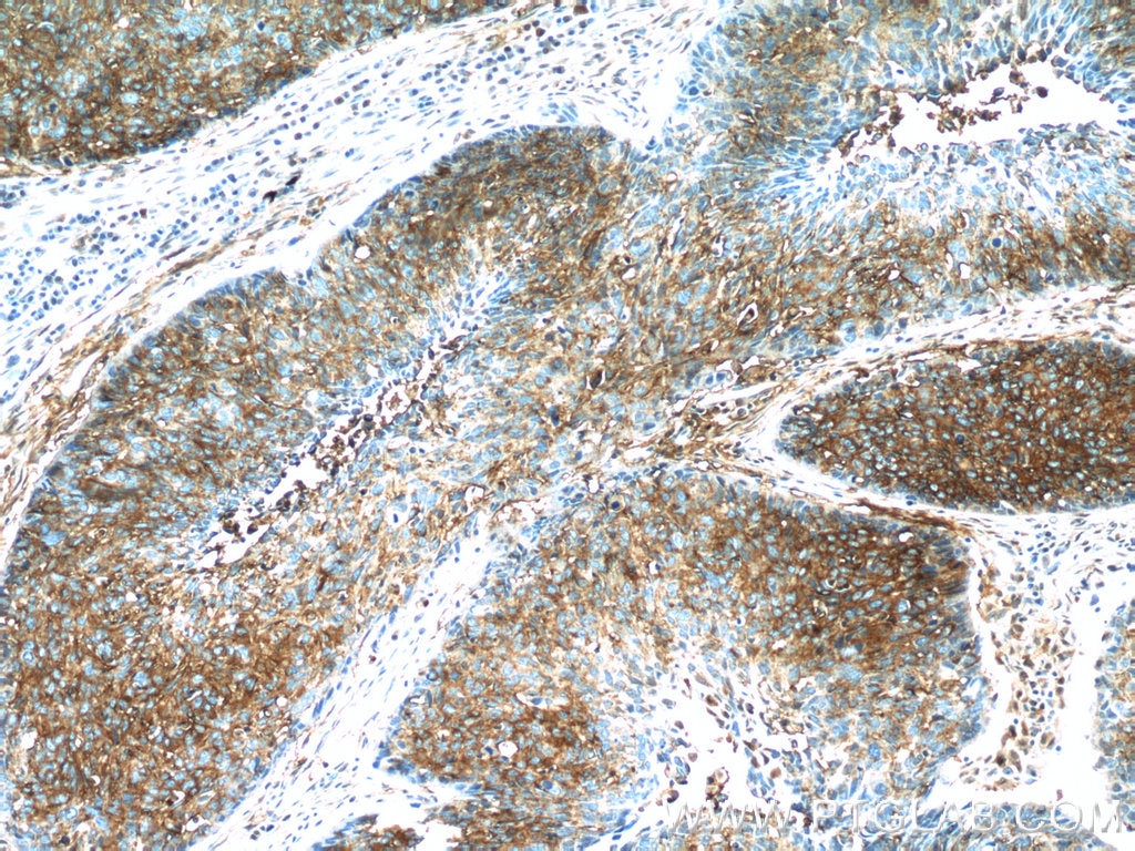 Immunohistochemistry (IHC) staining of human lung cancer tissue using APOL2 Polyclonal antibody (25925-1-AP)