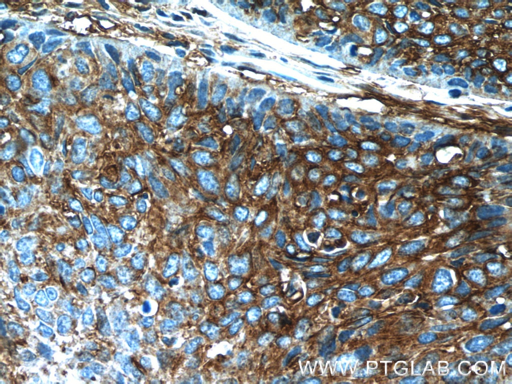 Immunohistochemistry (IHC) staining of human lung cancer tissue using APOL2 Polyclonal antibody (25925-1-AP)