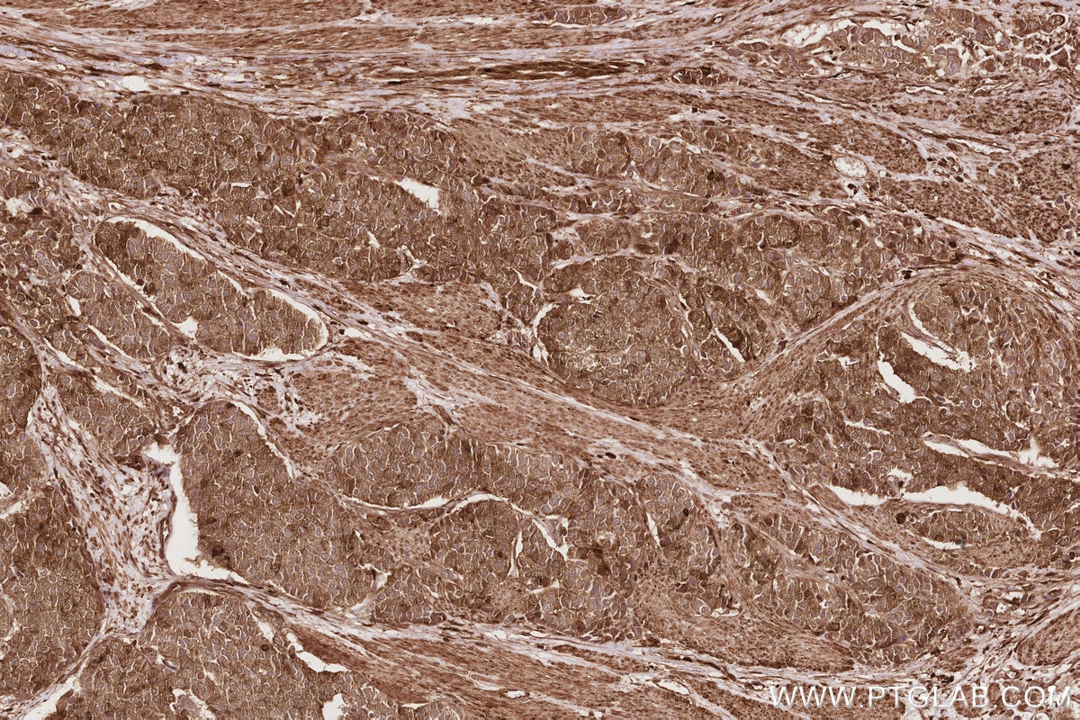 Immunohistochemistry (IHC) staining of human stomach cancer tissue using APOL2 Polyclonal antibody (25925-1-AP)