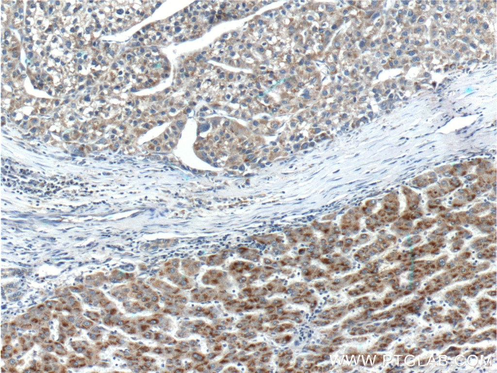 Immunohistochemistry (IHC) staining of human liver cancer tissue using APOL4 Polyclonal antibody (10564-1-AP)