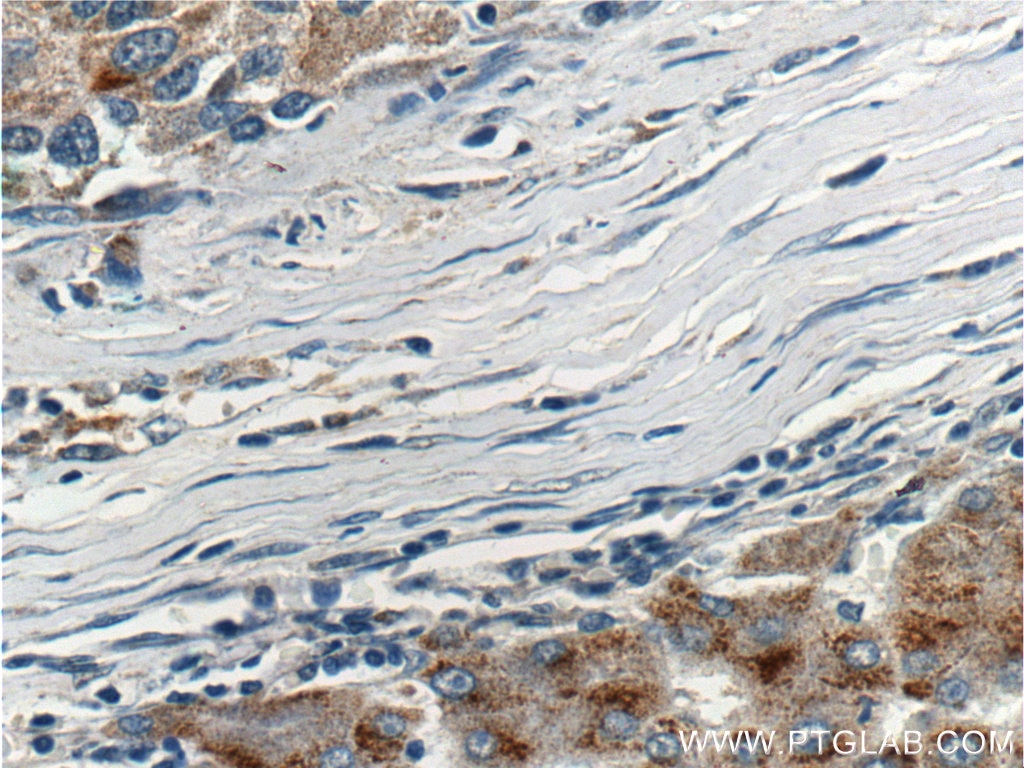 IHC staining of human liver cancer using 10564-1-AP