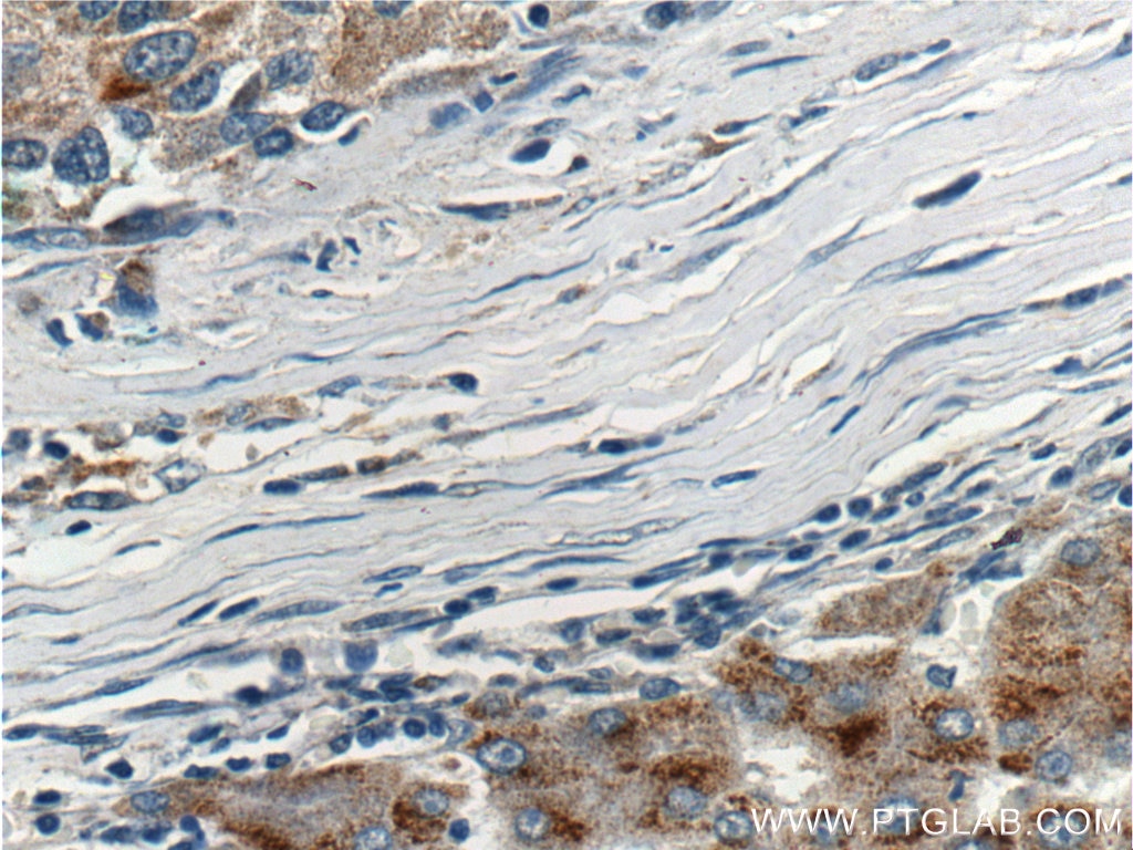 Immunohistochemistry (IHC) staining of human liver cancer tissue using APOL4 Polyclonal antibody (10564-1-AP)