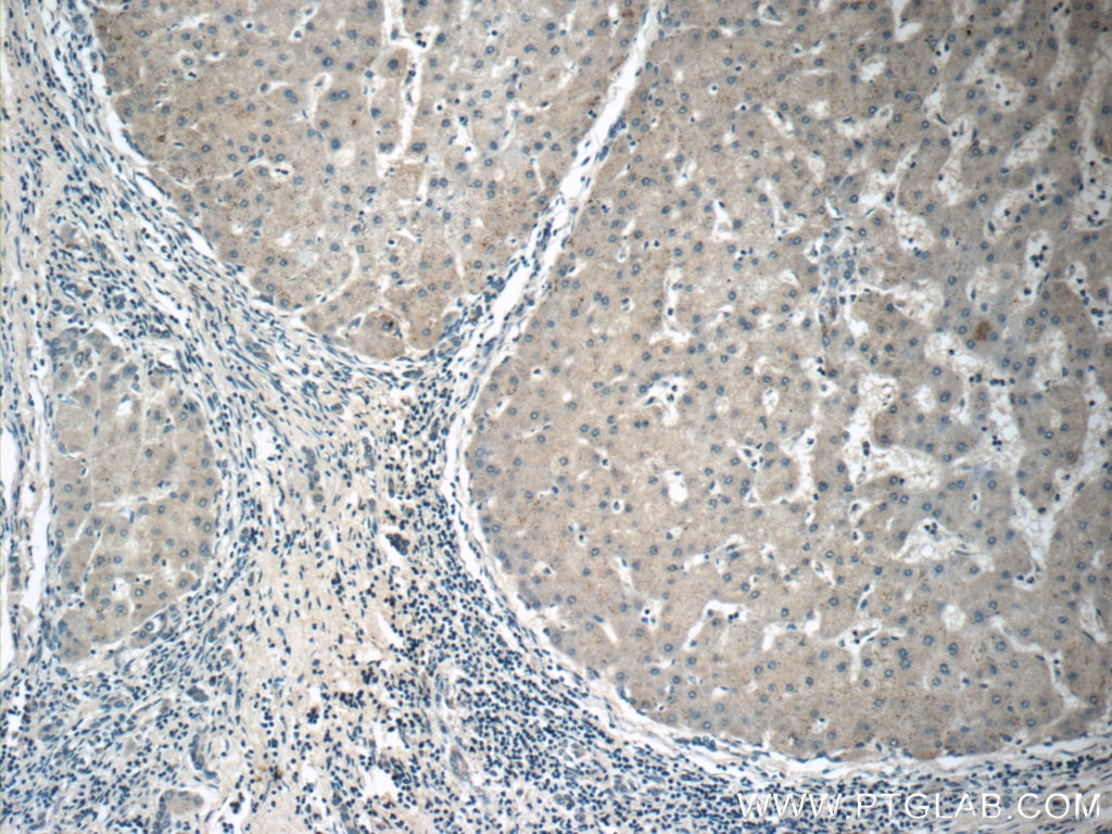 Immunohistochemistry (IHC) staining of human hepatocirrhosis tissue using APOM Polyclonal antibody (12817-1-AP)