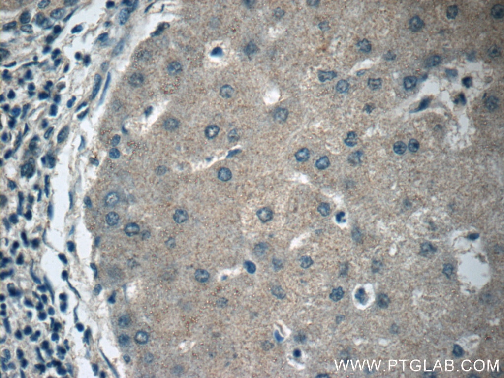 Immunohistochemistry (IHC) staining of human hepatocirrhosis tissue using APOM Polyclonal antibody (12817-1-AP)