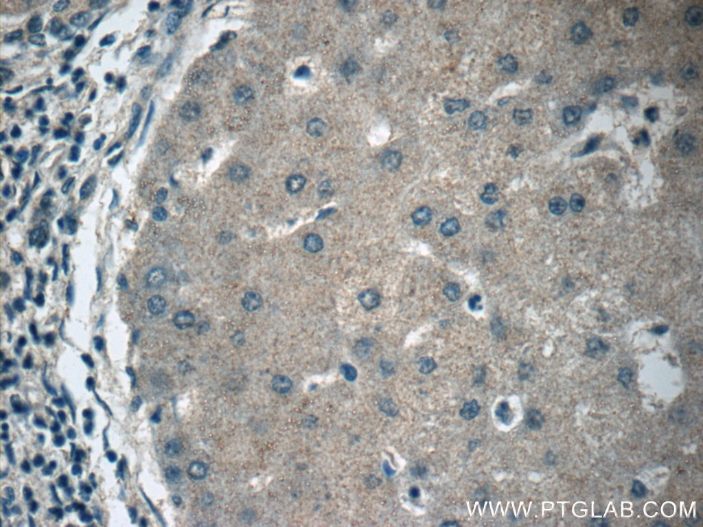 IHC staining of human hepatocirrhosis using 12817-1-AP