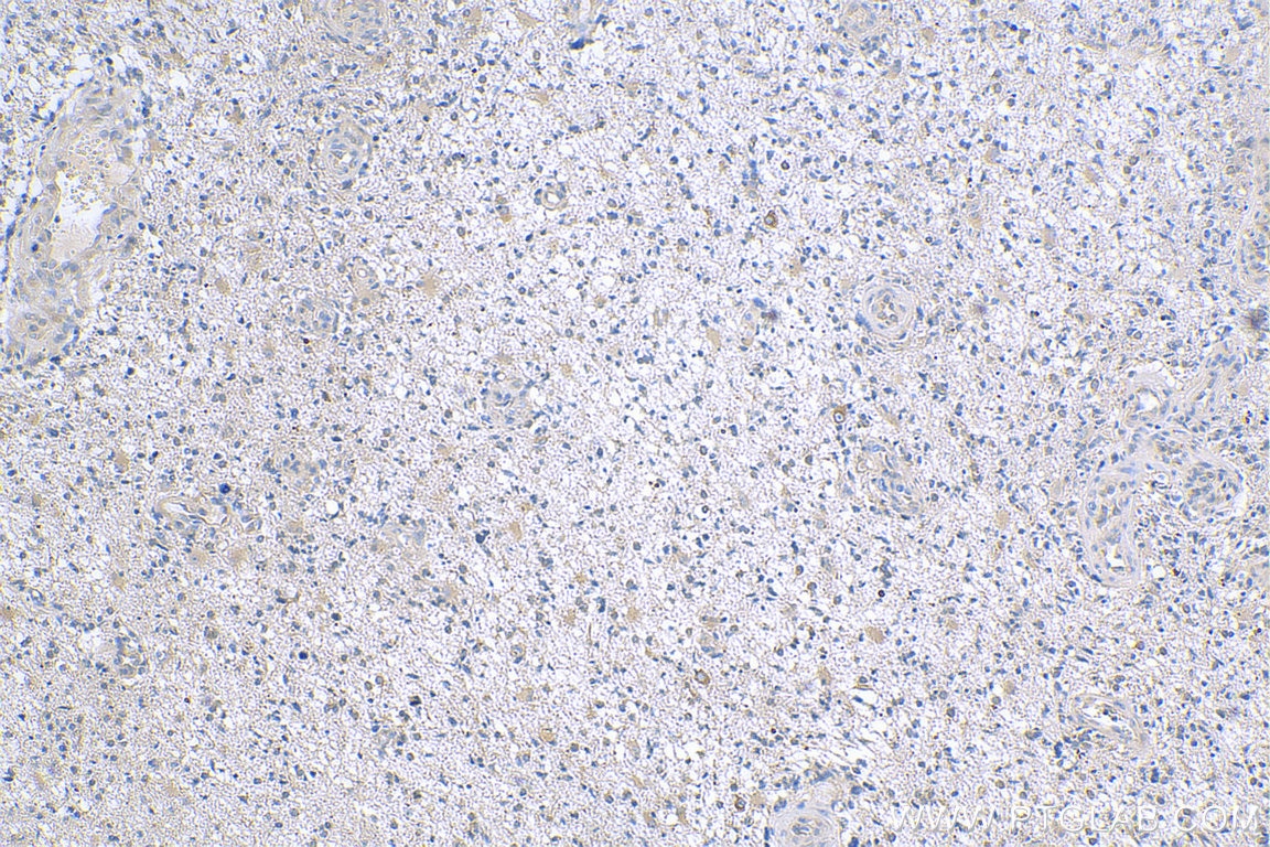 Immunohistochemistry (IHC) staining of human gliomas tissue using APP Monoclonal antibody (60342-1-Ig)