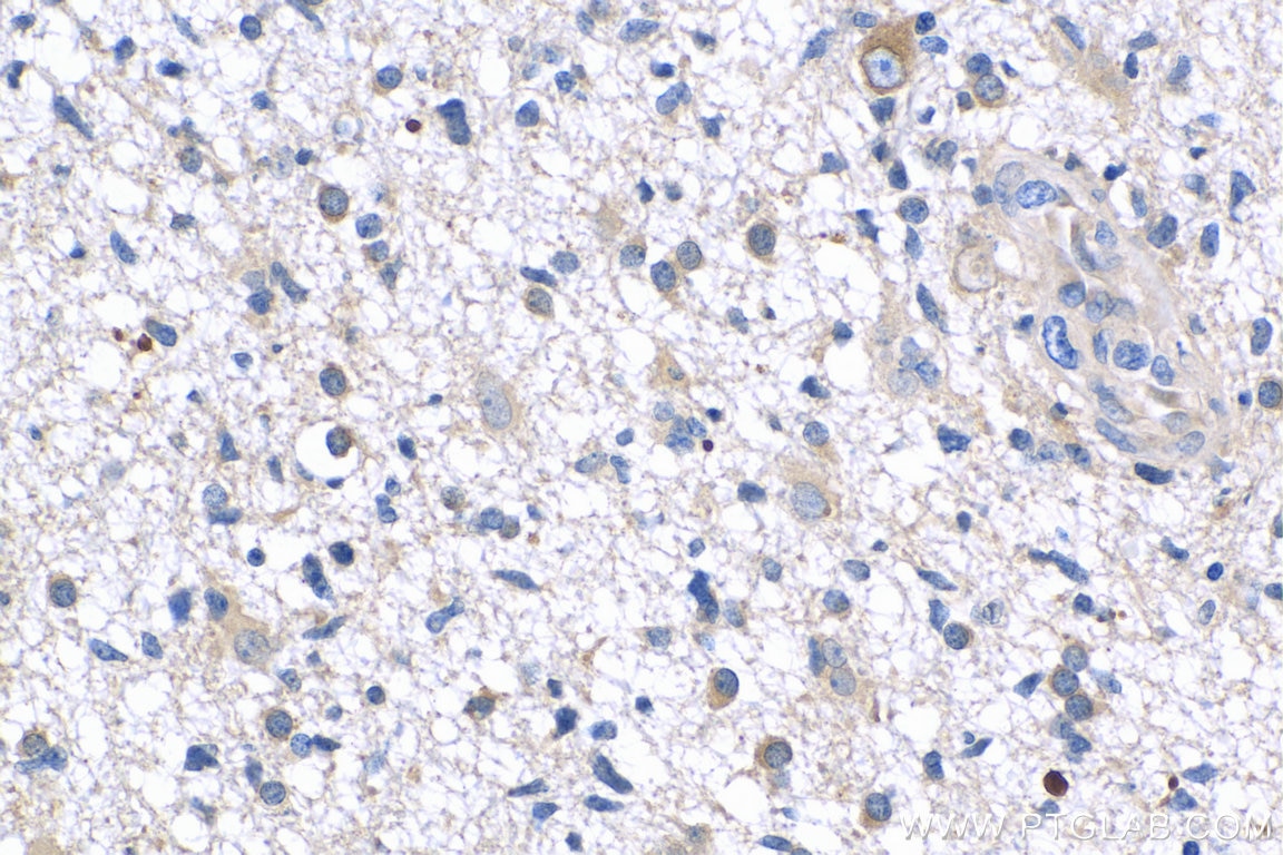 Immunohistochemistry (IHC) staining of human gliomas tissue using APP Monoclonal antibody (60342-1-Ig)