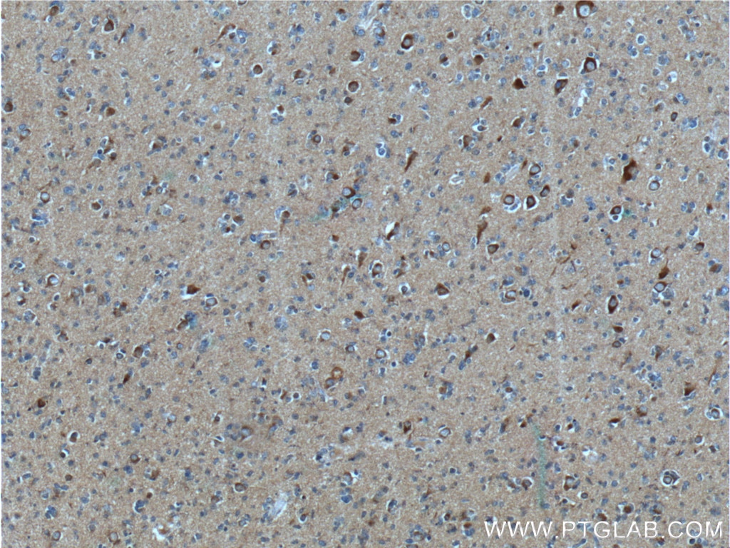 Immunohistochemistry (IHC) staining of human gliomas tissue using APP Monoclonal antibody (60342-1-Ig)