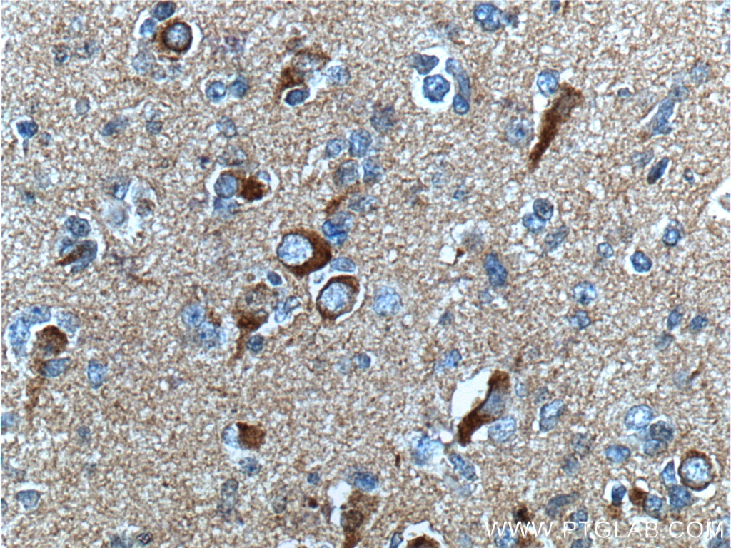 Immunohistochemistry (IHC) staining of human gliomas tissue using APP Monoclonal antibody (60342-1-Ig)