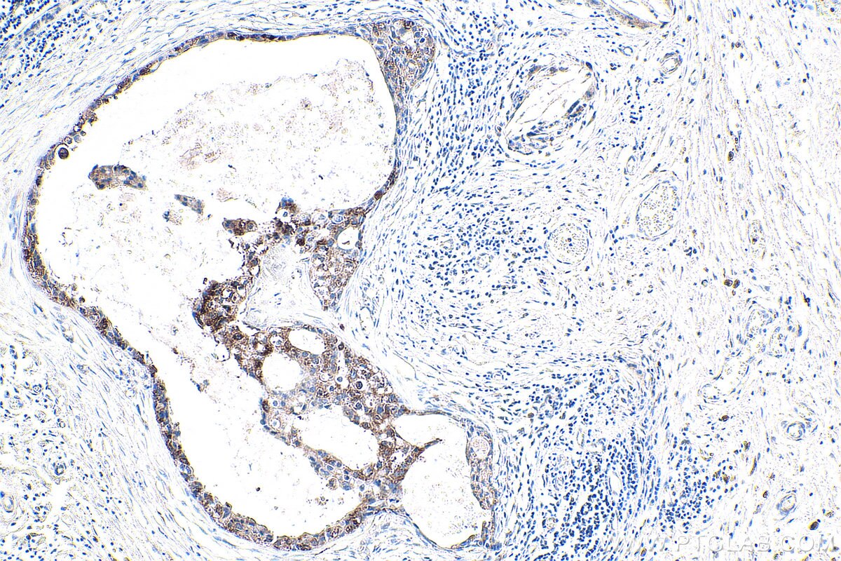 IHC staining of human breast cancer using 12409-1-AP