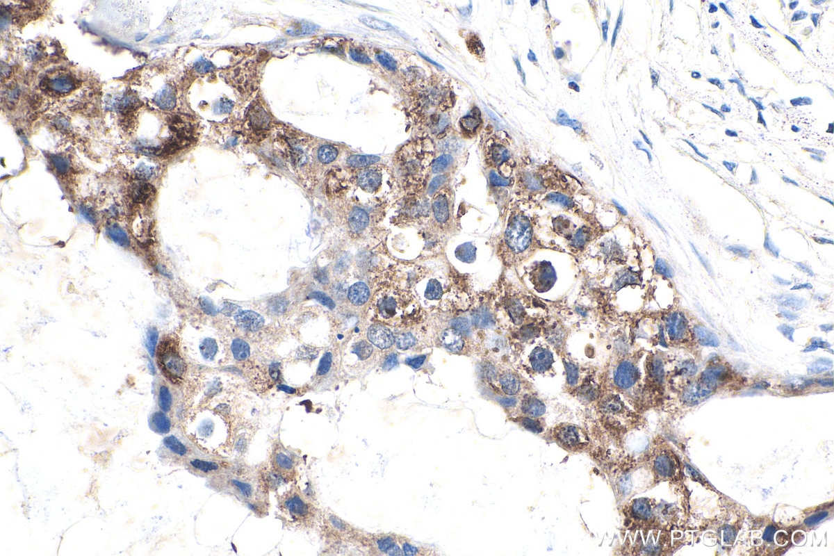 Immunohistochemistry (IHC) staining of human breast cancer tissue using APPBP2 Polyclonal antibody (12409-1-AP)