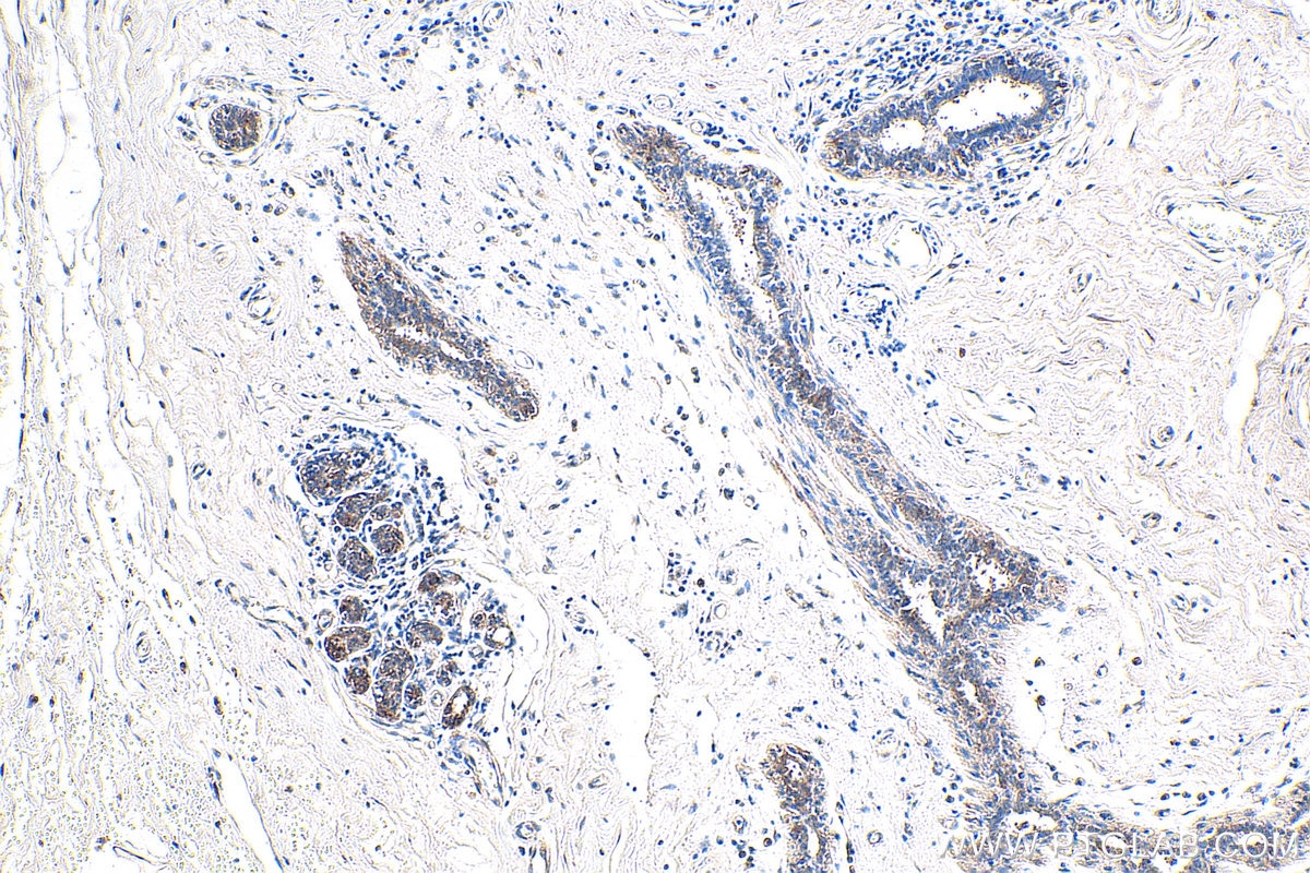 Immunohistochemistry (IHC) staining of human breast cancer tissue using APPBP2 Polyclonal antibody (12409-1-AP)
