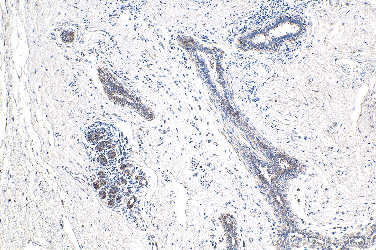 IHC staining of human breast cancer using 12409-1-AP