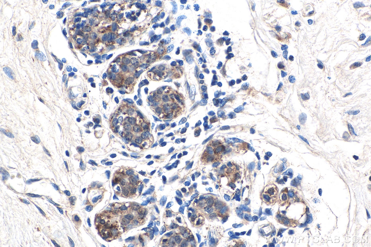 Immunohistochemistry (IHC) staining of human breast cancer tissue using APPBP2 Polyclonal antibody (12409-1-AP)