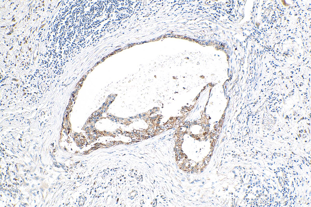 IHC staining of human breast cancer using 12409-1-AP