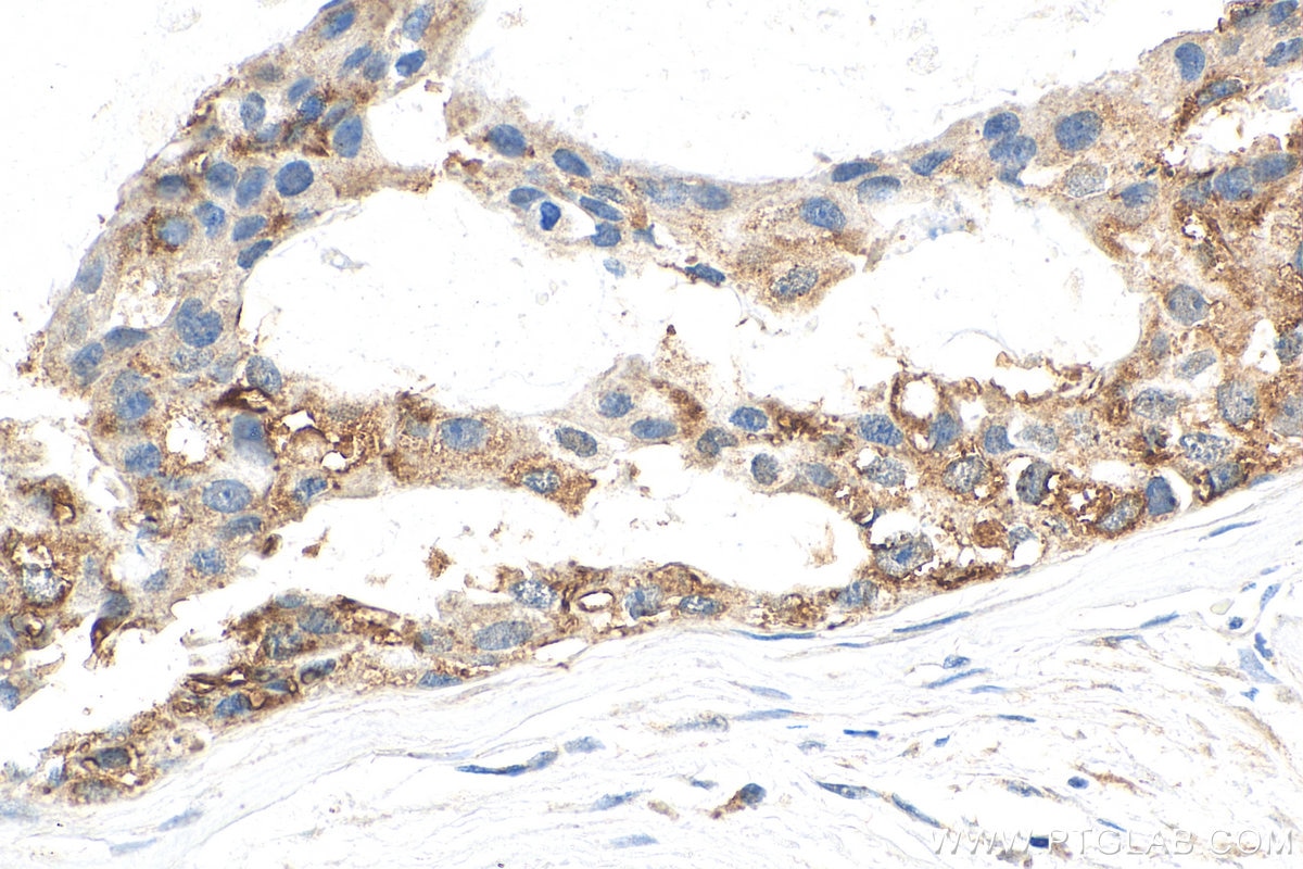 Immunohistochemistry (IHC) staining of human breast cancer tissue using APPBP2 Polyclonal antibody (12409-1-AP)