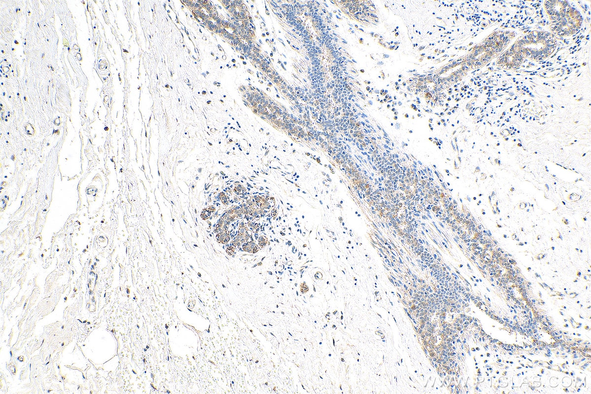 Immunohistochemistry (IHC) staining of human breast cancer tissue using APPBP2 Polyclonal antibody (12409-1-AP)