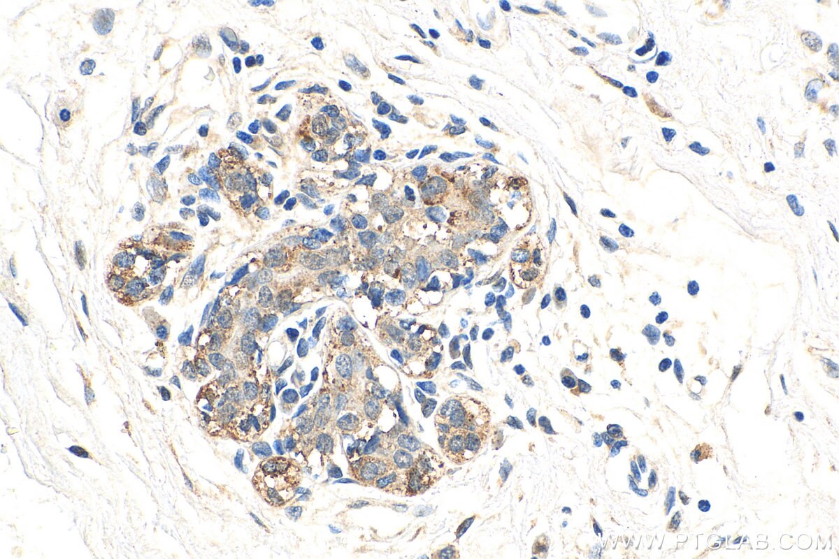 Immunohistochemistry (IHC) staining of human breast cancer tissue using APPBP2 Polyclonal antibody (12409-1-AP)