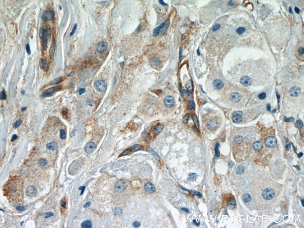 Immunohistochemistry (IHC) staining of human breast cancer tissue using APPL1 Polyclonal antibody (19885-1-AP)