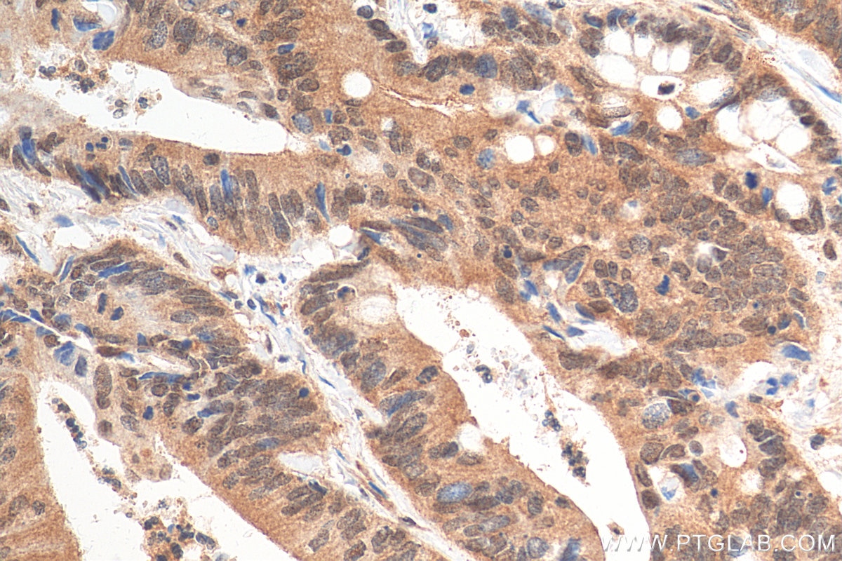 Immunohistochemistry (IHC) staining of human colon cancer tissue using APPL1 Monoclonal antibody (68195-1-Ig)