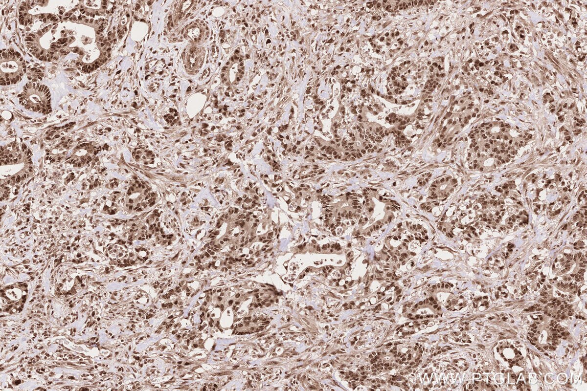 Immunohistochemistry (IHC) staining of human rectal cancer tissue using APTX Polyclonal antibody (26747-1-AP)