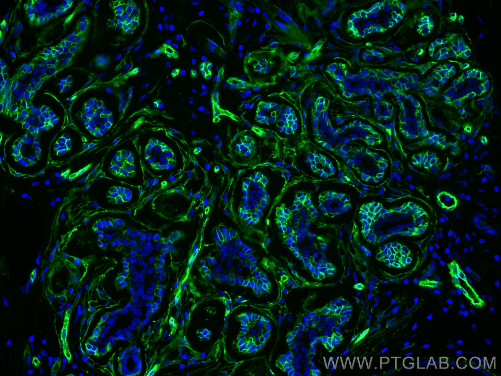 Immunofluorescence (IF) / fluorescent staining of human breast cancer tissue using AQP1 Polyclonal antibody (20333-1-AP)