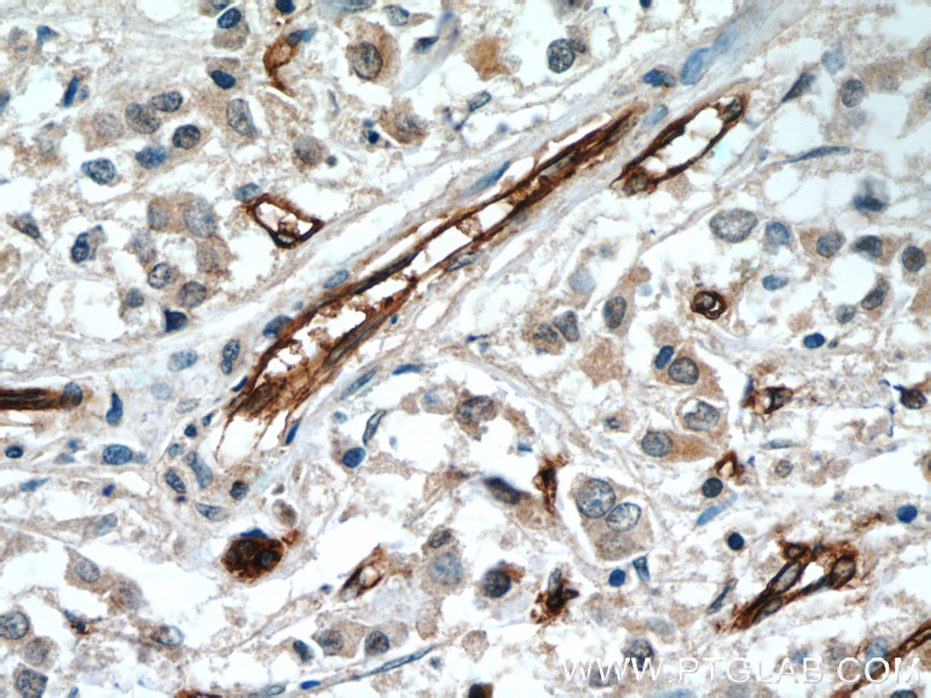 IHC staining of human breast cancer using 20333-1-AP