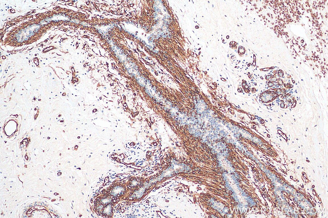 IHC staining of human breast cancer using 20333-1-AP