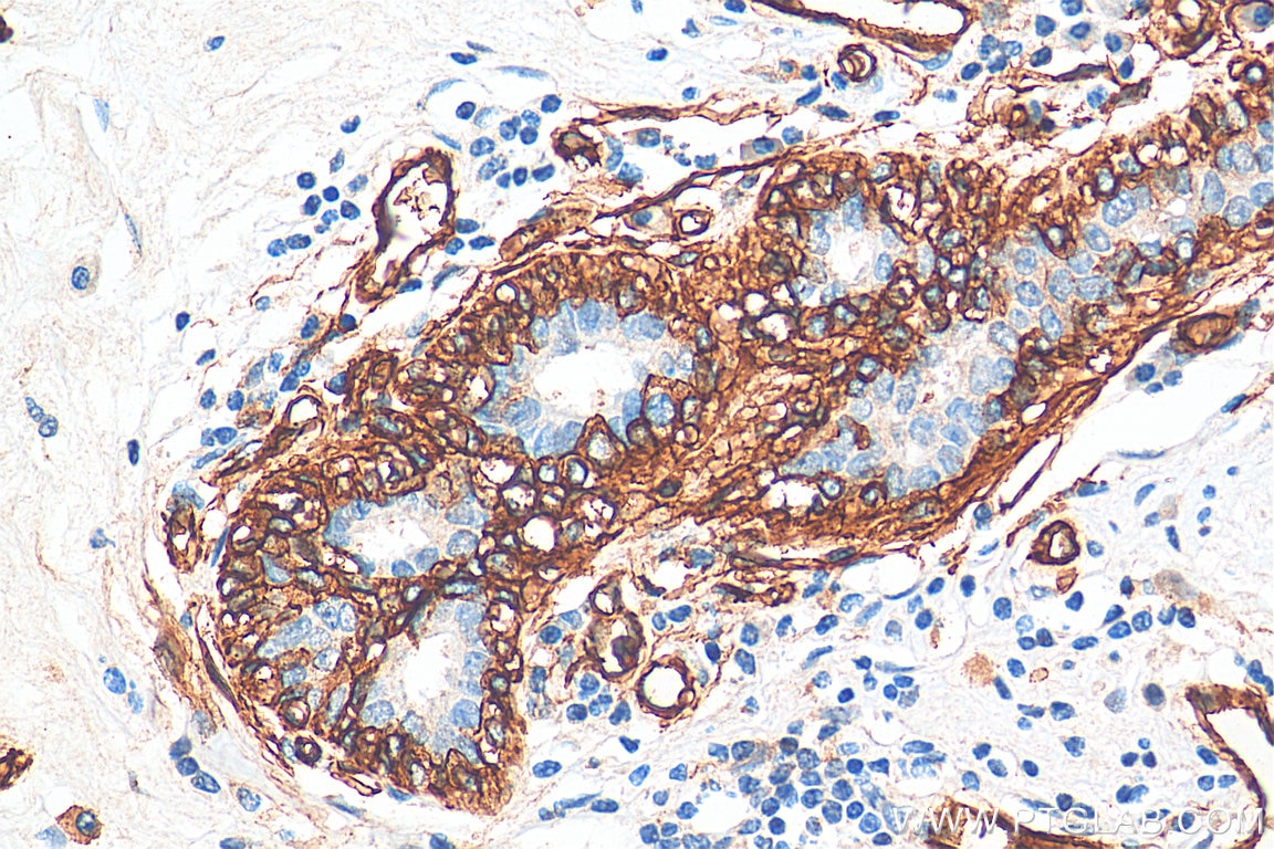 Immunohistochemistry (IHC) staining of human breast cancer tissue using AQP1 Polyclonal antibody (20333-1-AP)
