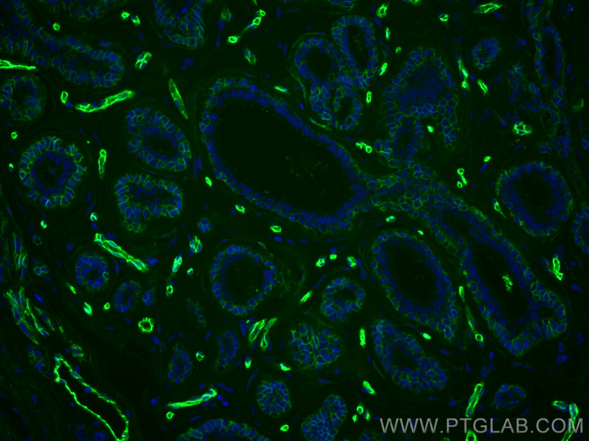 Immunofluorescence (IF) / fluorescent staining of human breast cancer tissue using CoraLite® Plus 488-conjugated AQP1 Polyclonal anti (CL488-20333)