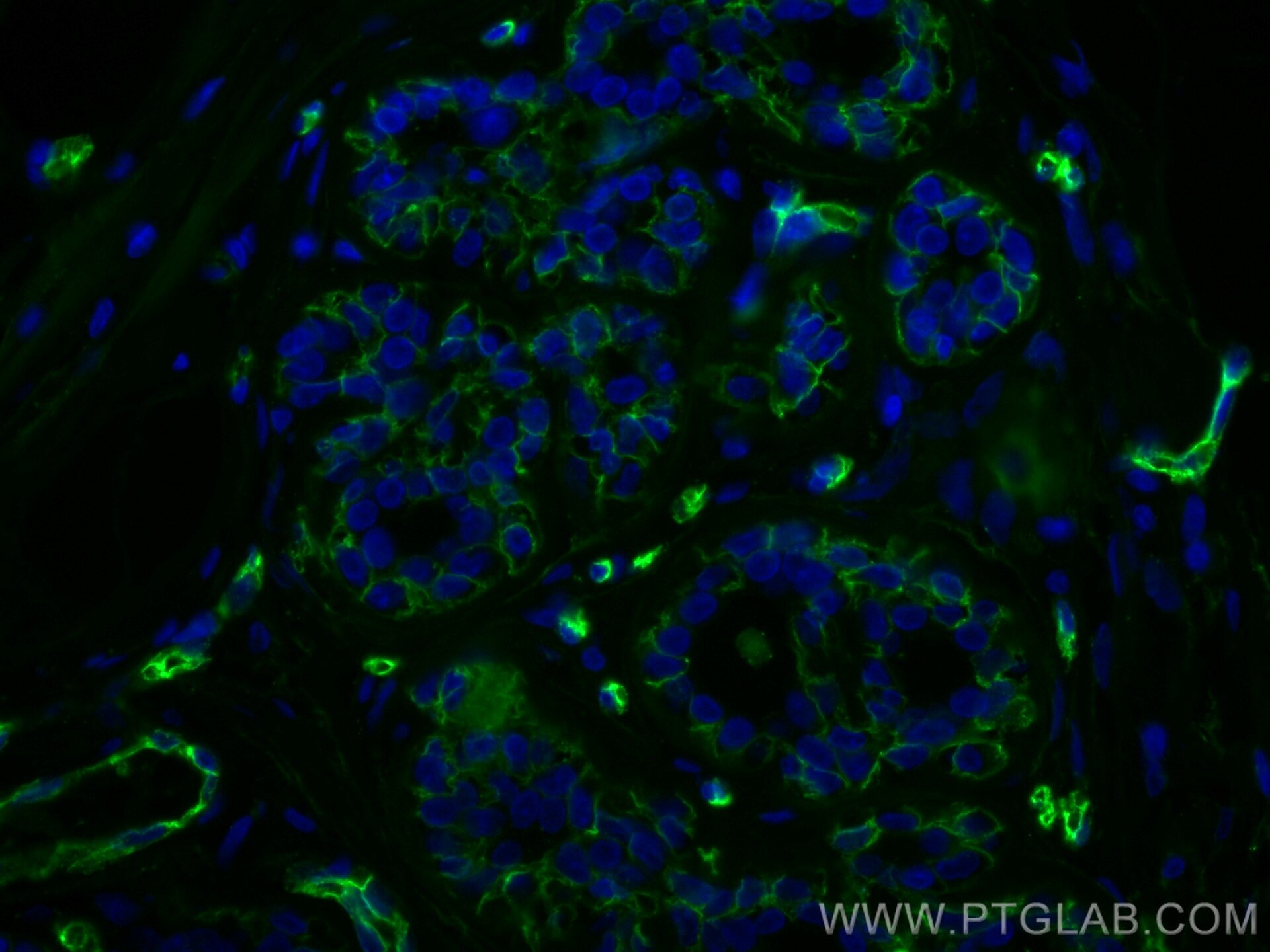 Immunofluorescence (IF) / fluorescent staining of human breast cancer tissue using CoraLite® Plus 488-conjugated AQP1 Polyclonal anti (CL488-20333)