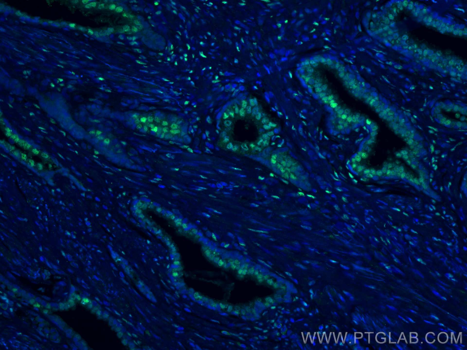 Immunofluorescence (IF) / fluorescent staining of human prostate cancer tissue using androgen receptor Polyclonal antibody (22089-1-AP)