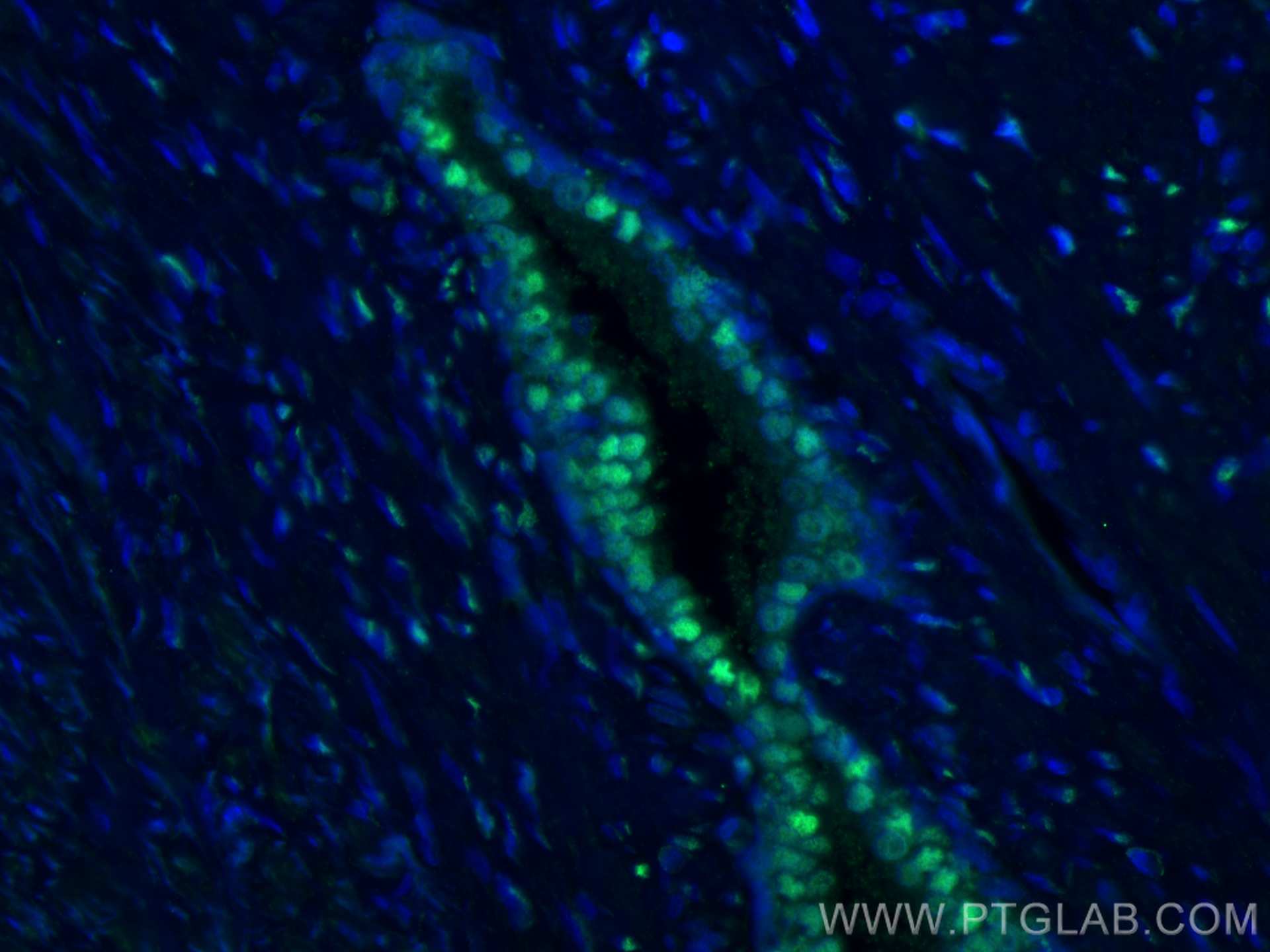 IF Staining of human prostate cancer using 22089-1-AP