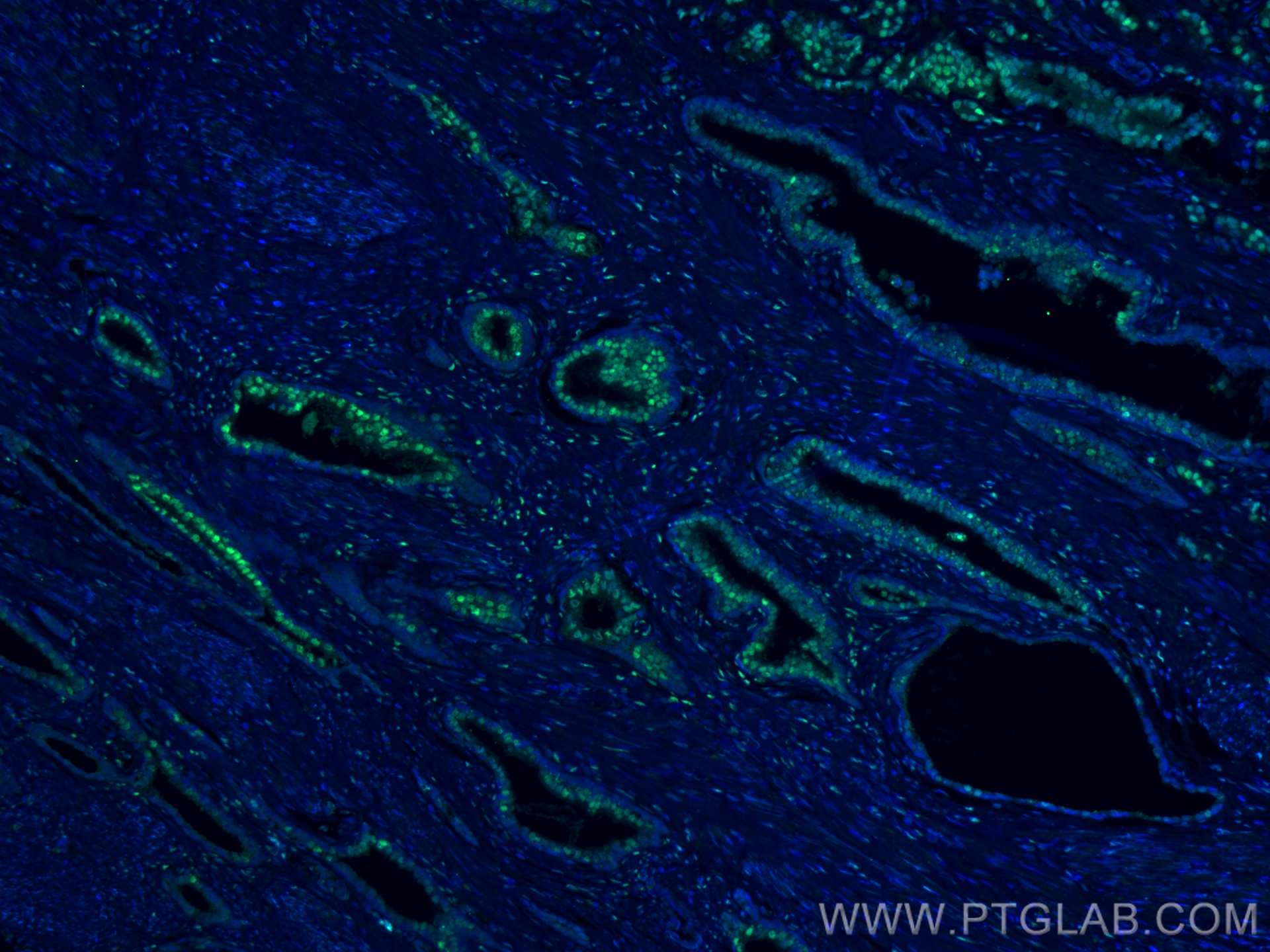 Immunofluorescence (IF) / fluorescent staining of human prostate cancer tissue using androgen receptor Polyclonal antibody (22089-1-AP)