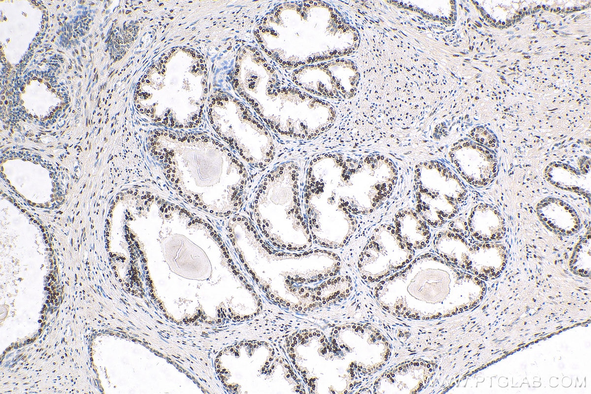 Immunohistochemistry (IHC) staining of human prostate cancer tissue using androgen receptor Polyclonal antibody (22089-1-AP)