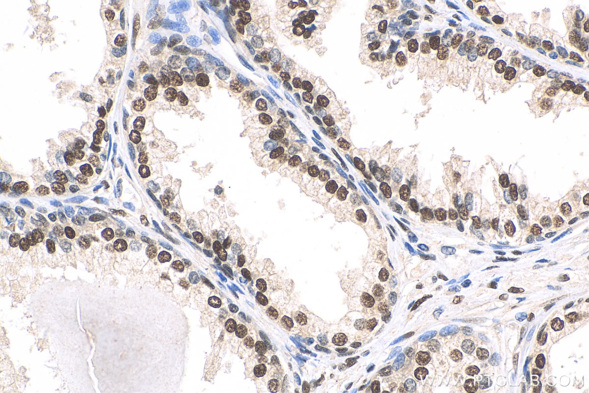 Immunohistochemistry (IHC) staining of human prostate cancer tissue using androgen receptor Polyclonal antibody (22089-1-AP)