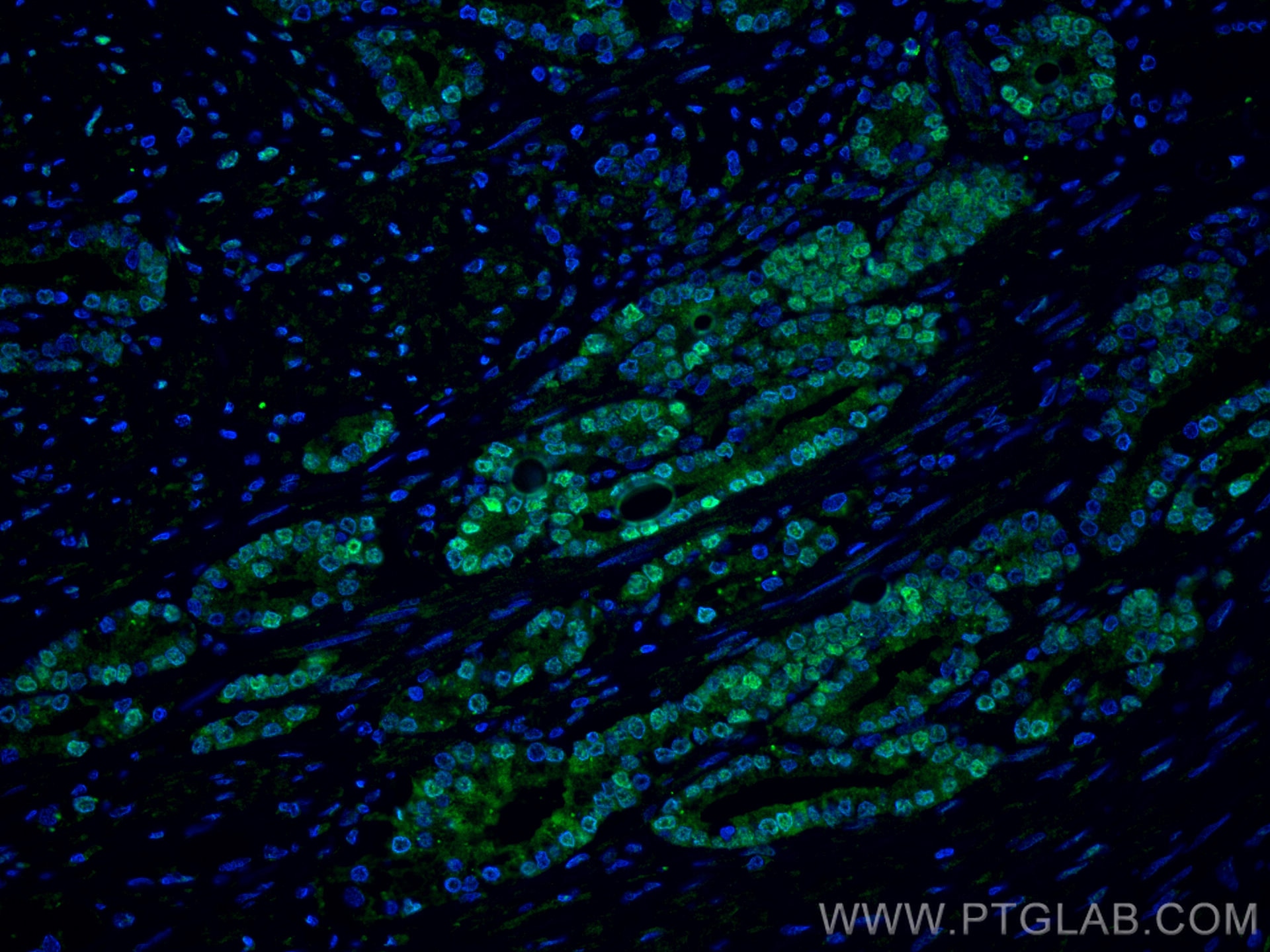 Immunofluorescence (IF) / fluorescent staining of human prostate cancer tissue using androgen receptor Monoclonal antibody (66747-1-Ig)