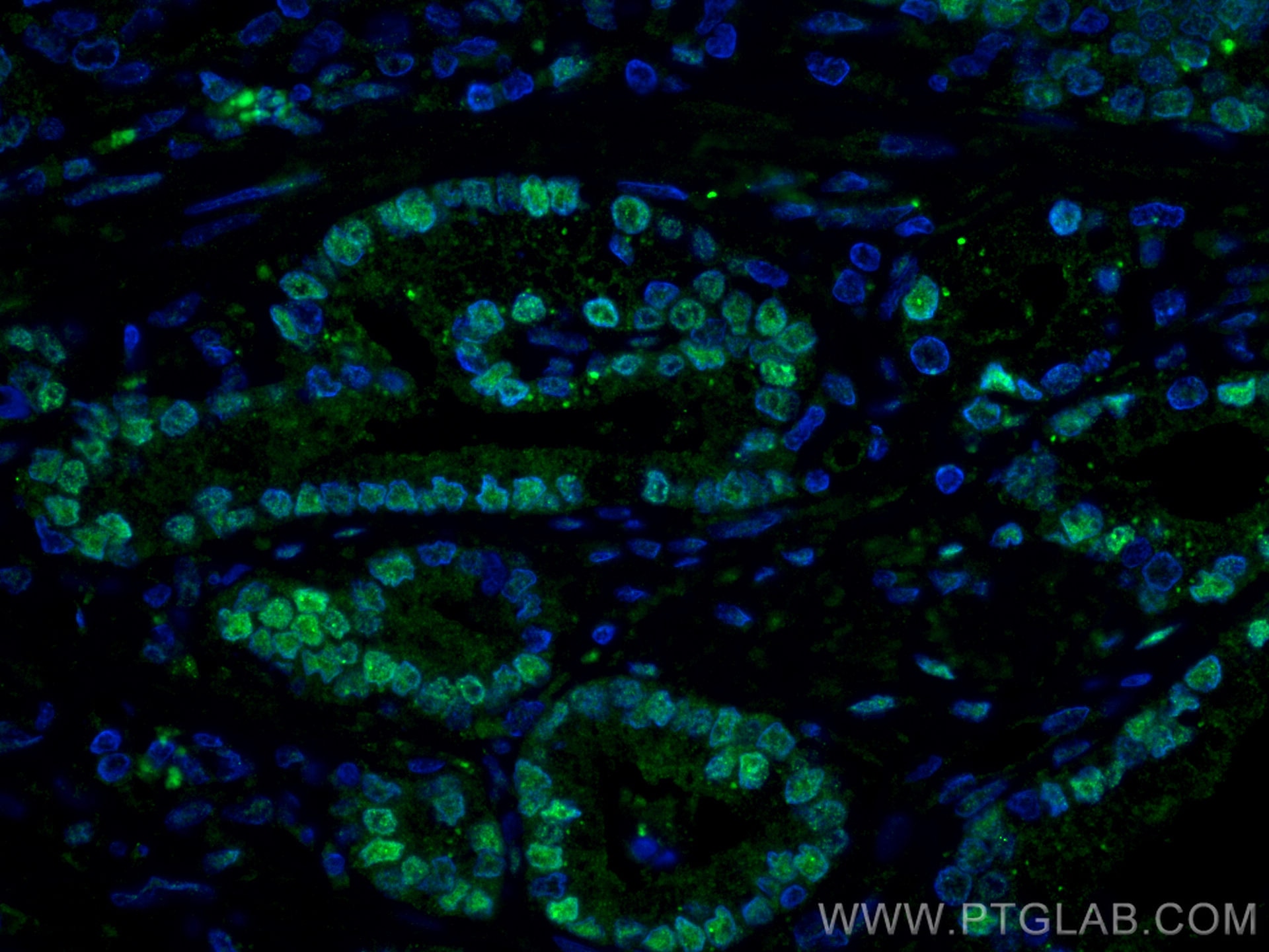 Immunofluorescence (IF) / fluorescent staining of human prostate cancer tissue using androgen receptor Monoclonal antibody (66747-1-Ig)