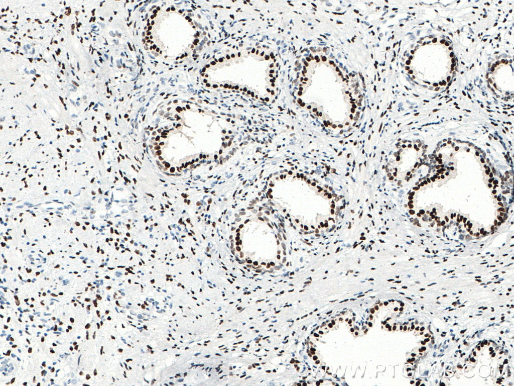 Immunohistochemistry (IHC) staining of human prostate cancer tissue using androgen receptor Monoclonal antibody (66747-1-Ig)