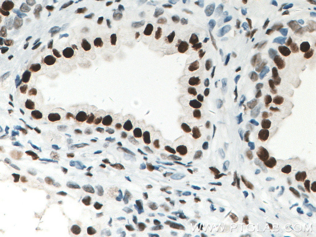 Immunohistochemistry (IHC) staining of human prostate cancer tissue using androgen receptor Monoclonal antibody (66747-1-Ig)