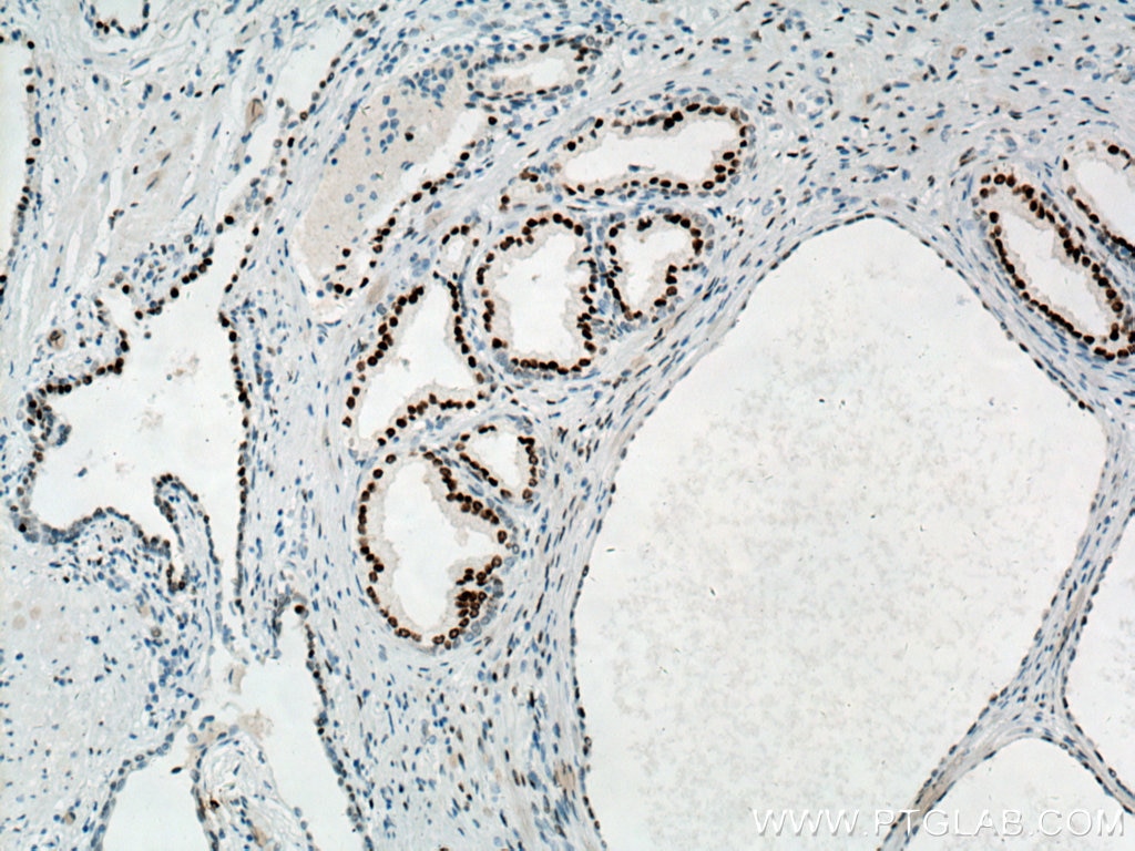 Immunohistochemistry (IHC) staining of human prostate cancer tissue using androgen receptor Monoclonal antibody (66747-1-Ig)