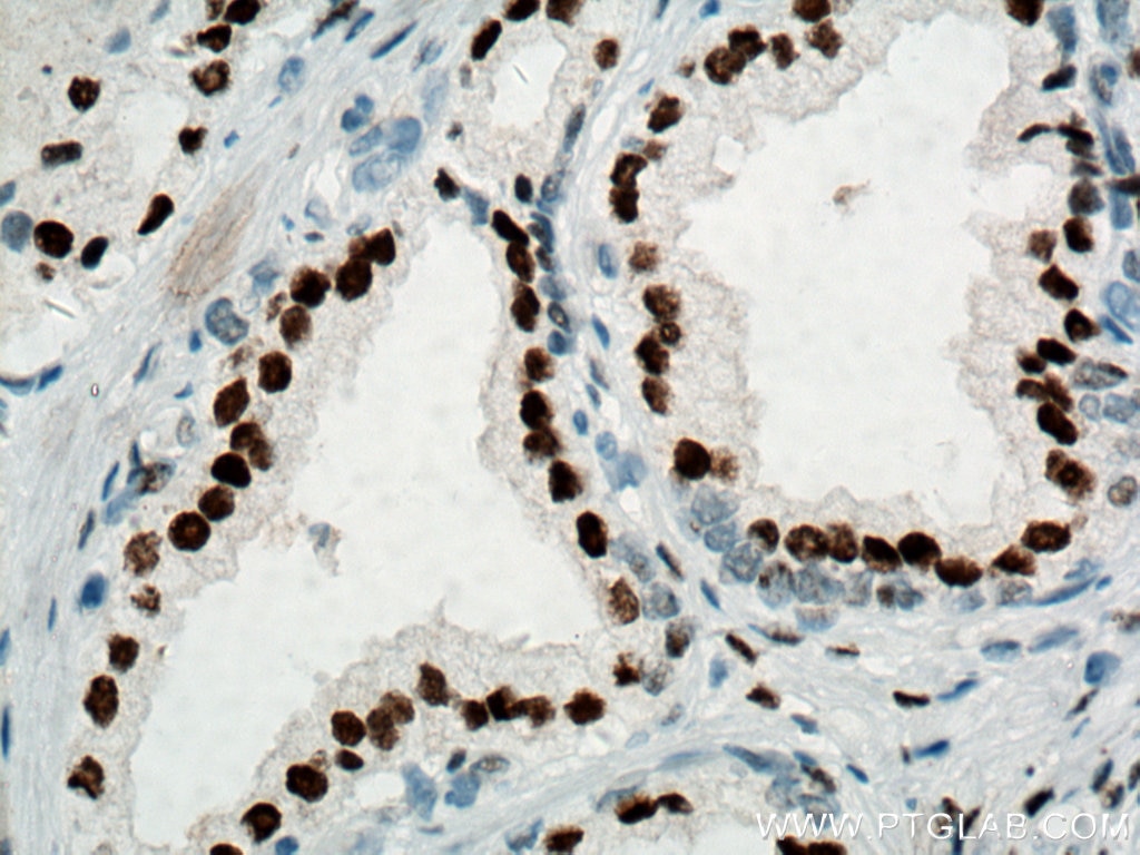 IHC staining of human prostate cancer using 66747-1-Ig